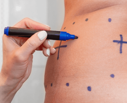 21 Things You Should Know About Liposuction